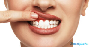 Oral Health Probiotics: Inflammation Fighters